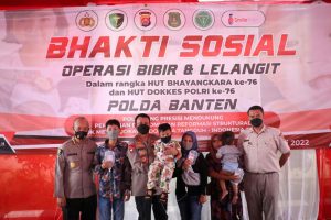 Polda Banten Gelar Operasi Bibir Sumbing dan Lelangit Gratis